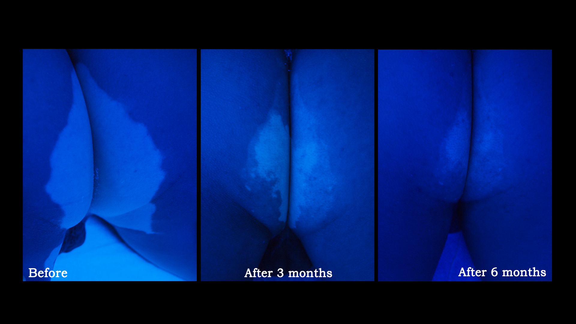 Cases of vitiligo in young ages | Vitiligo Center ... for Wood Lamp Vitiligo
146hul Cases of vitiligo in young ages | Vitiligo Center ... for Wood Lamp Vitiligo
146hul