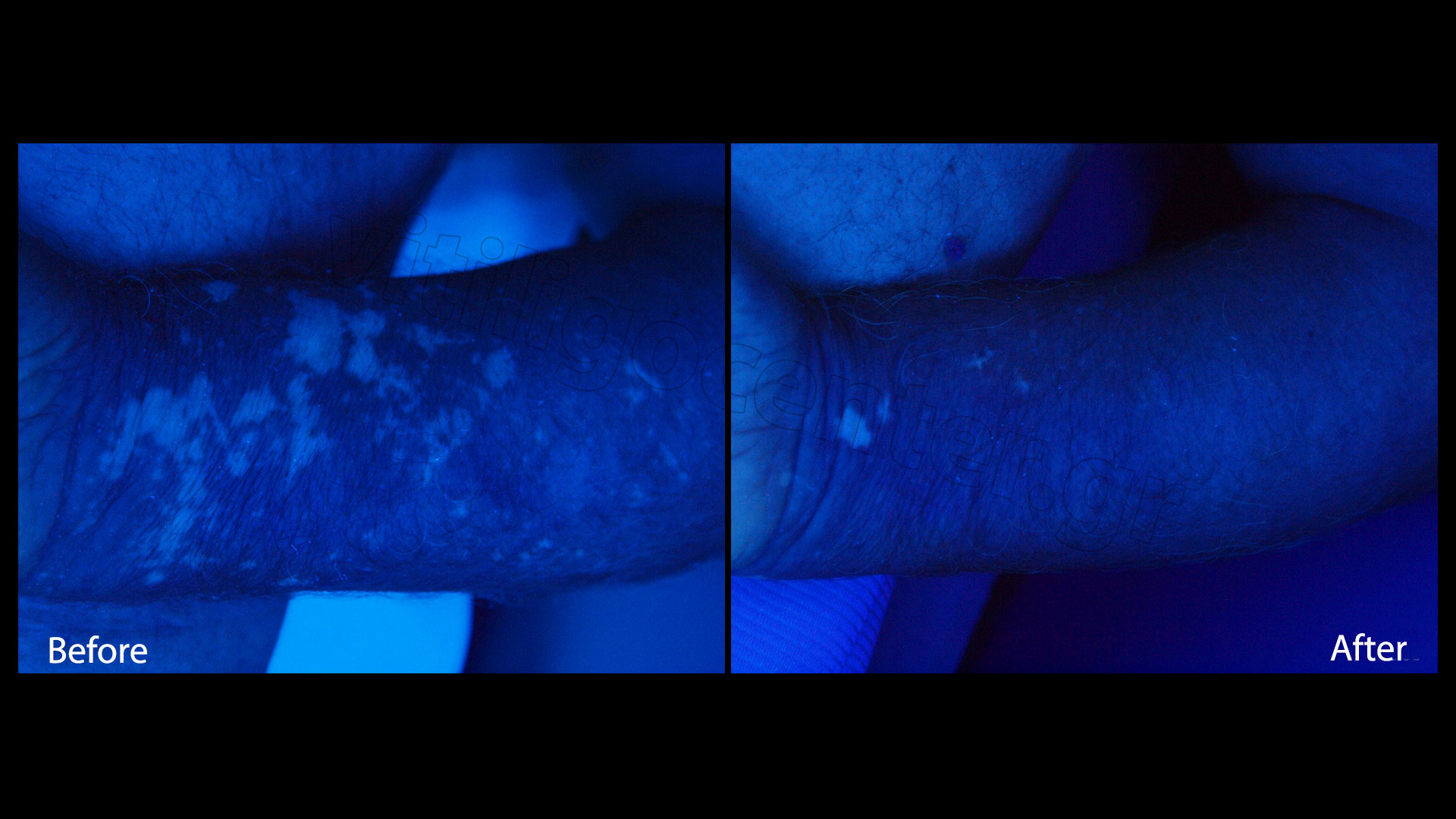 Medical cases of vitiligo | Vitiligo Center - Psychodermatologic ... for Wood Lamp Vitiligo
186ref Medical cases of vitiligo | Vitiligo Center - Psychodermatologic ... for Wood Lamp Vitiligo
186ref