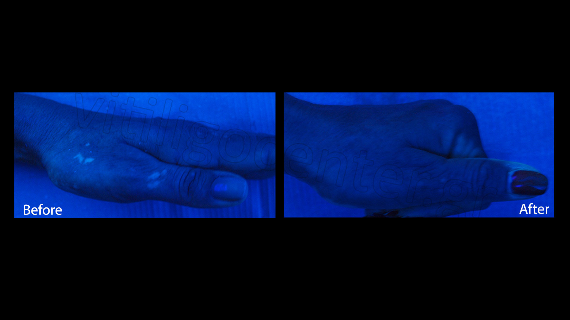 Medical cases of vitiligo | Vitiligo Center - Psychodermatologic ... for Wood Lamp Vitiligo
192sfw Medical cases of vitiligo | Vitiligo Center - Psychodermatologic ... for Wood Lamp Vitiligo
192sfw