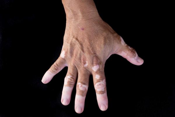 What are the symptoms of vitiligo?