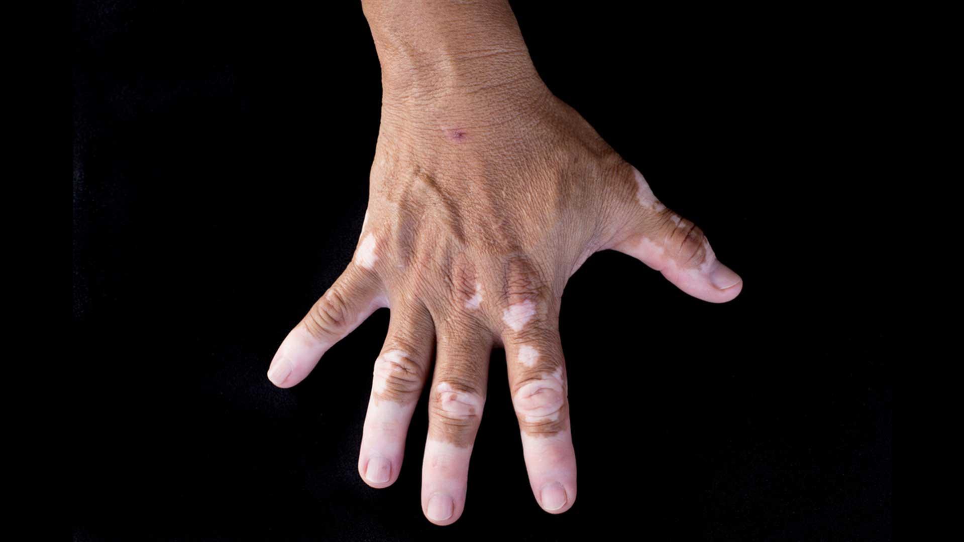 What are the symptoms of vitiligo?